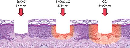 ablation-lasers-types