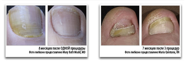 onychomycosis-before-after