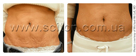 skintyte-abdomen