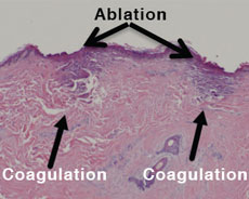 Гистология кожи после аблации лазером в пределах эпидермиса