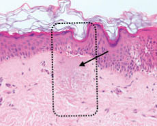 Гистология кожи после воздействия неабляционного фракционного лазера