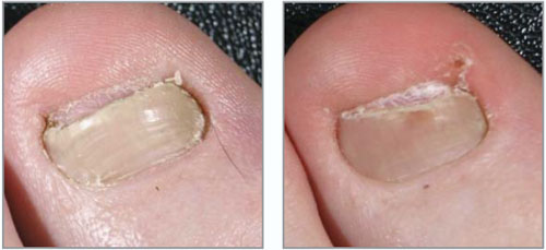  Грибок нігтів - лікування лазером Sciton ClearSilk