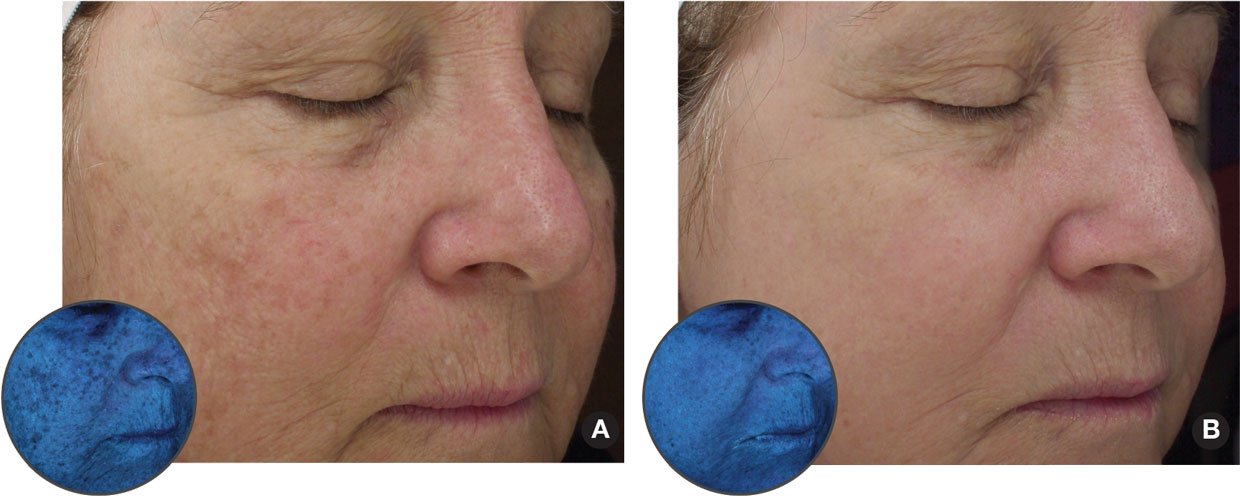 Гибридный фракционный лазер HALO: до и после омоложения кожи лица.